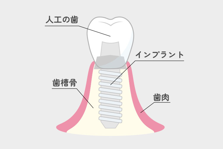 インプラントのイメージ画像